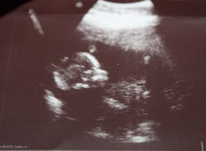 19 неделек и 2 дня, делала в жк, фотка вся смазанная(((