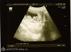 Узи срок 12недель